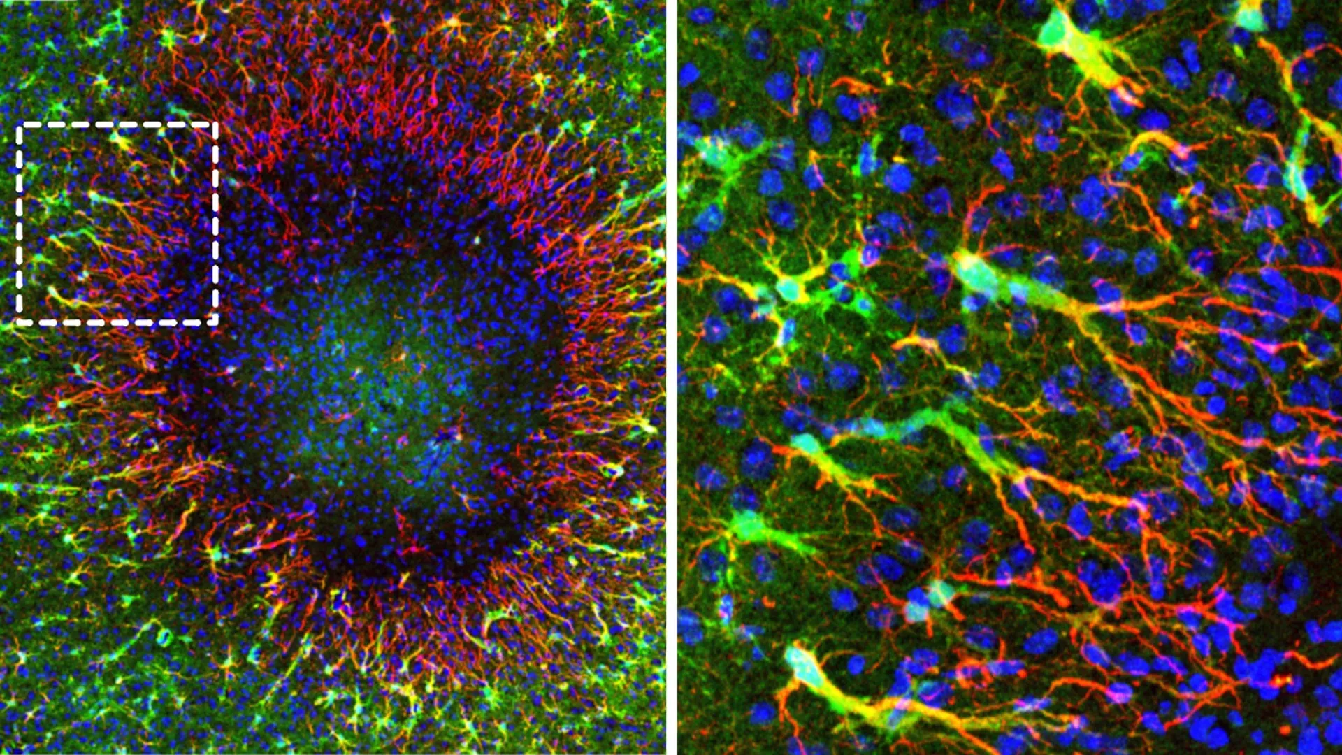 Micrografía de una lesión cerebral en la que se observan astrocitos alrededor del área dañada y núcleos celulares desplazándose hacia la zona de reparación.