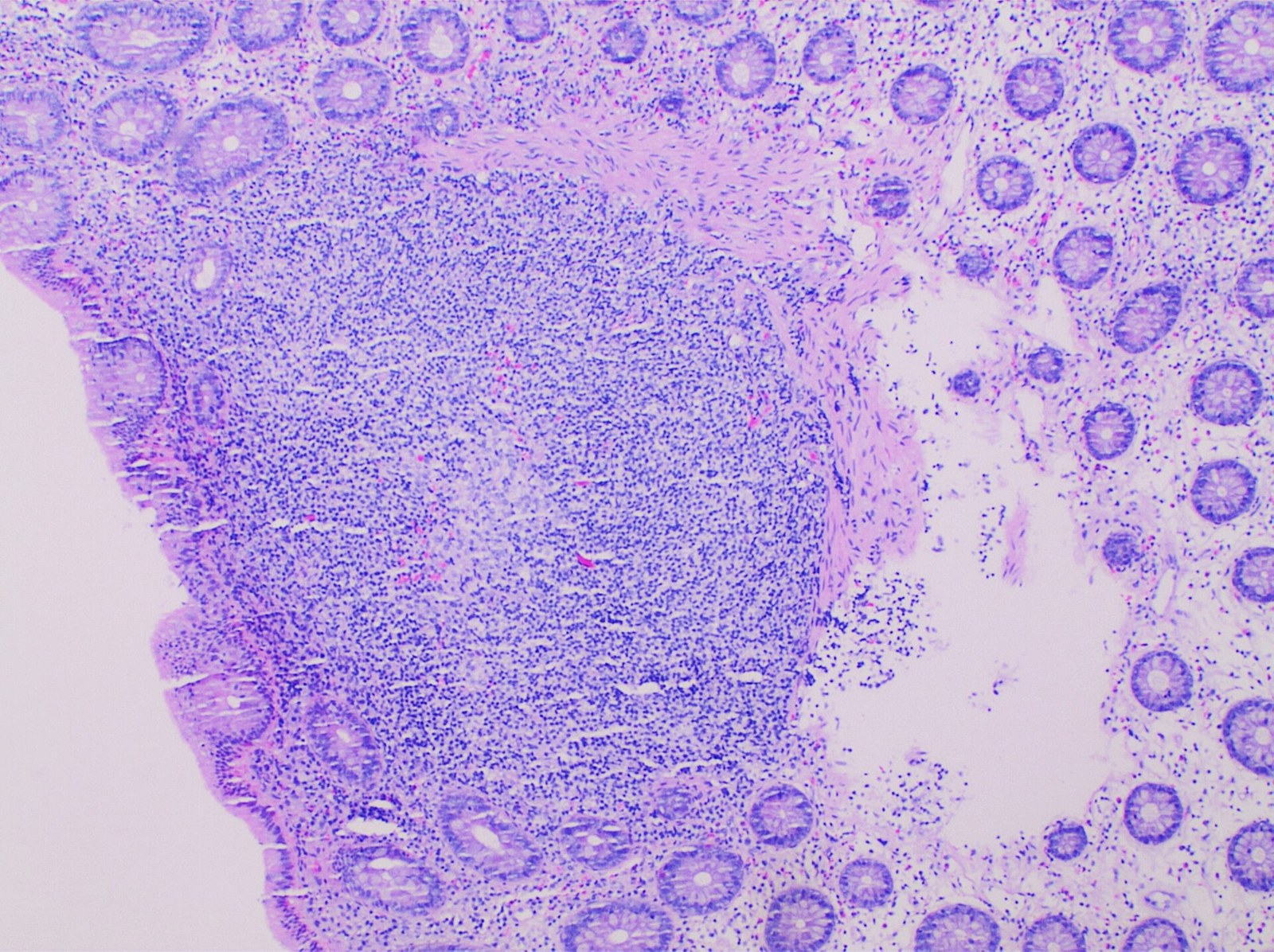 Micrografía histológica de tejido intestinal con agregado linfoide subepitelial.
