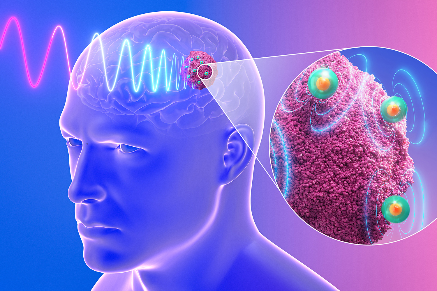 Ilustración de nanoantenas activadas por un campo magnético cerca de tejido de glioblastoma.