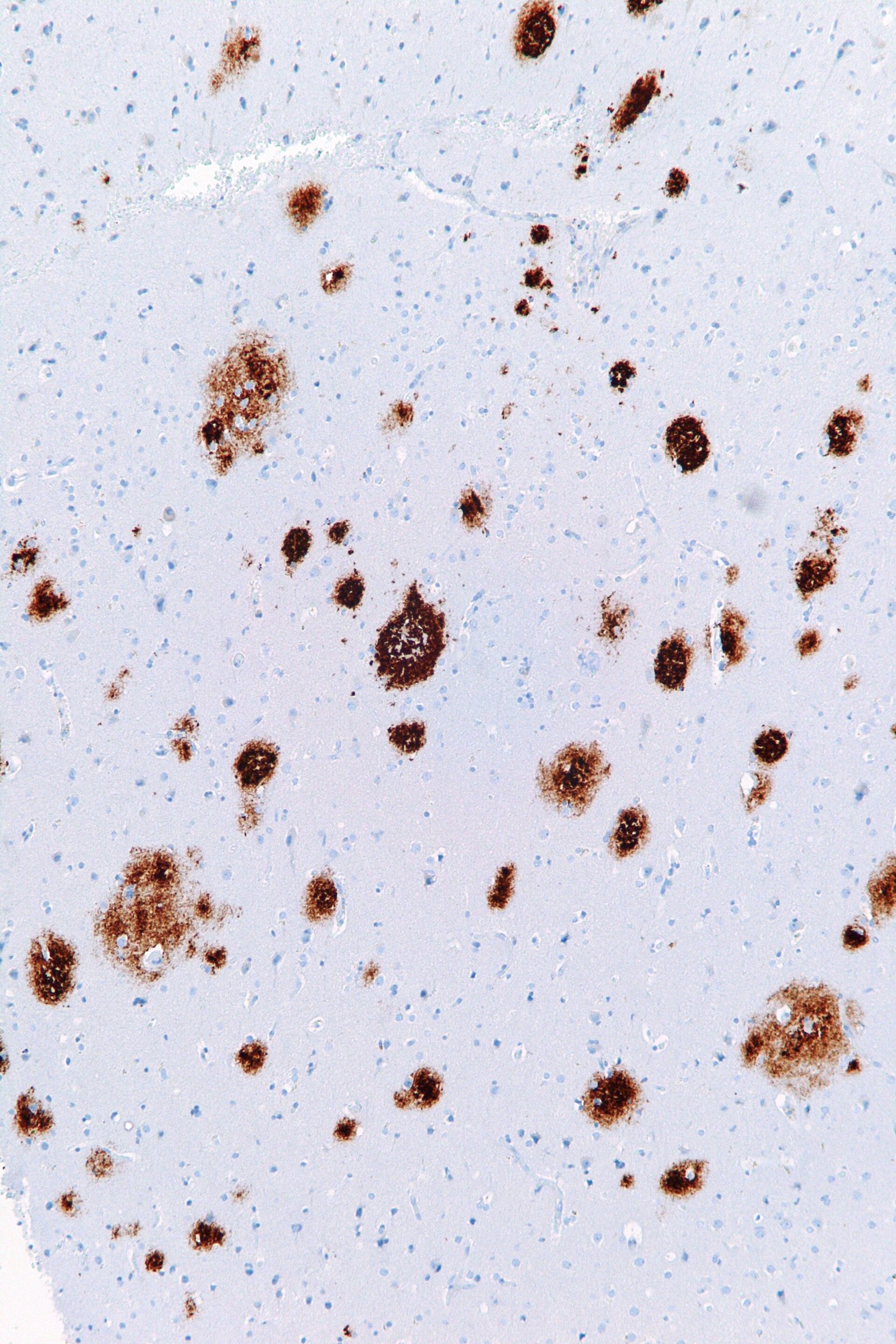 Micrografía histológica con depósitos en tejido cerebral.